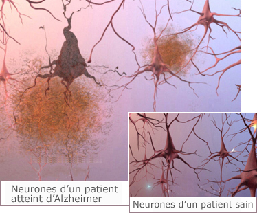 Neurones d'un patient atteint d'Alzheimer